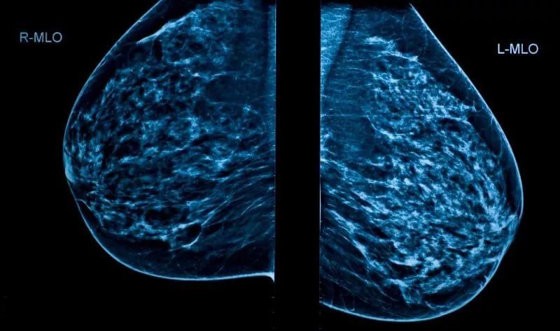 Mammogram images showing right and left breast views side by side in a diagnostic imaging display.