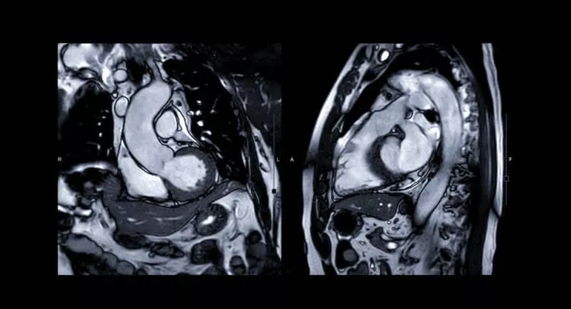 Cardiac MRI showing two cross-sectional views of the heart and aorta, highlighting cardiac chambers and major vessels.