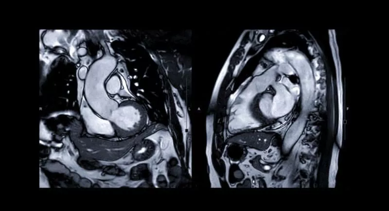 Cardiac MRI showing two cross-sectional views of the heart and aorta, highlighting cardiac chambers and major vessels.