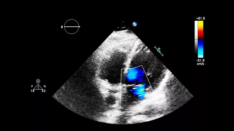 Cardiac ultrasound (echocardiogram) showing a heart chamber with colour Doppler overlay indicating blood flow direction and velocity.