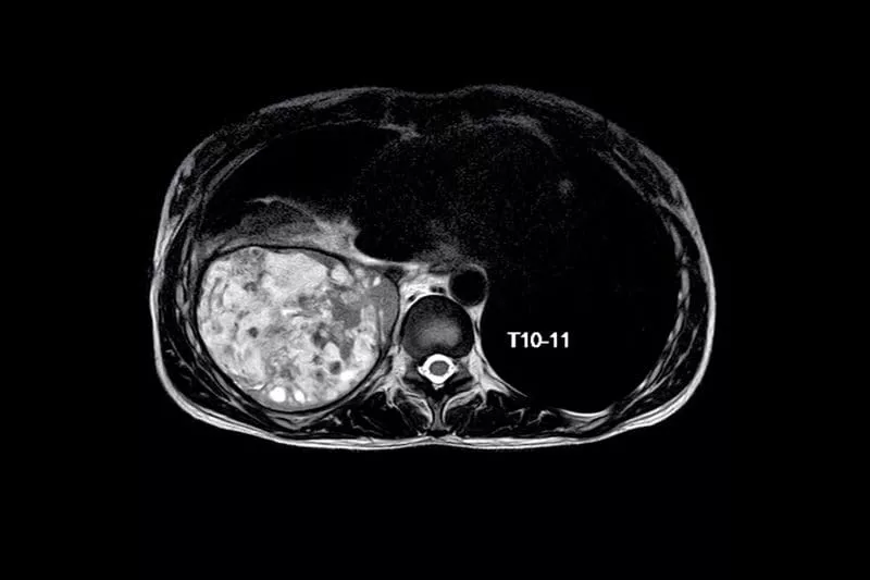 Axial MRI scan of the thoracic spine at the T10–T11 level, showing the vertebra, spinal canal, and surrounding soft tissue structures.