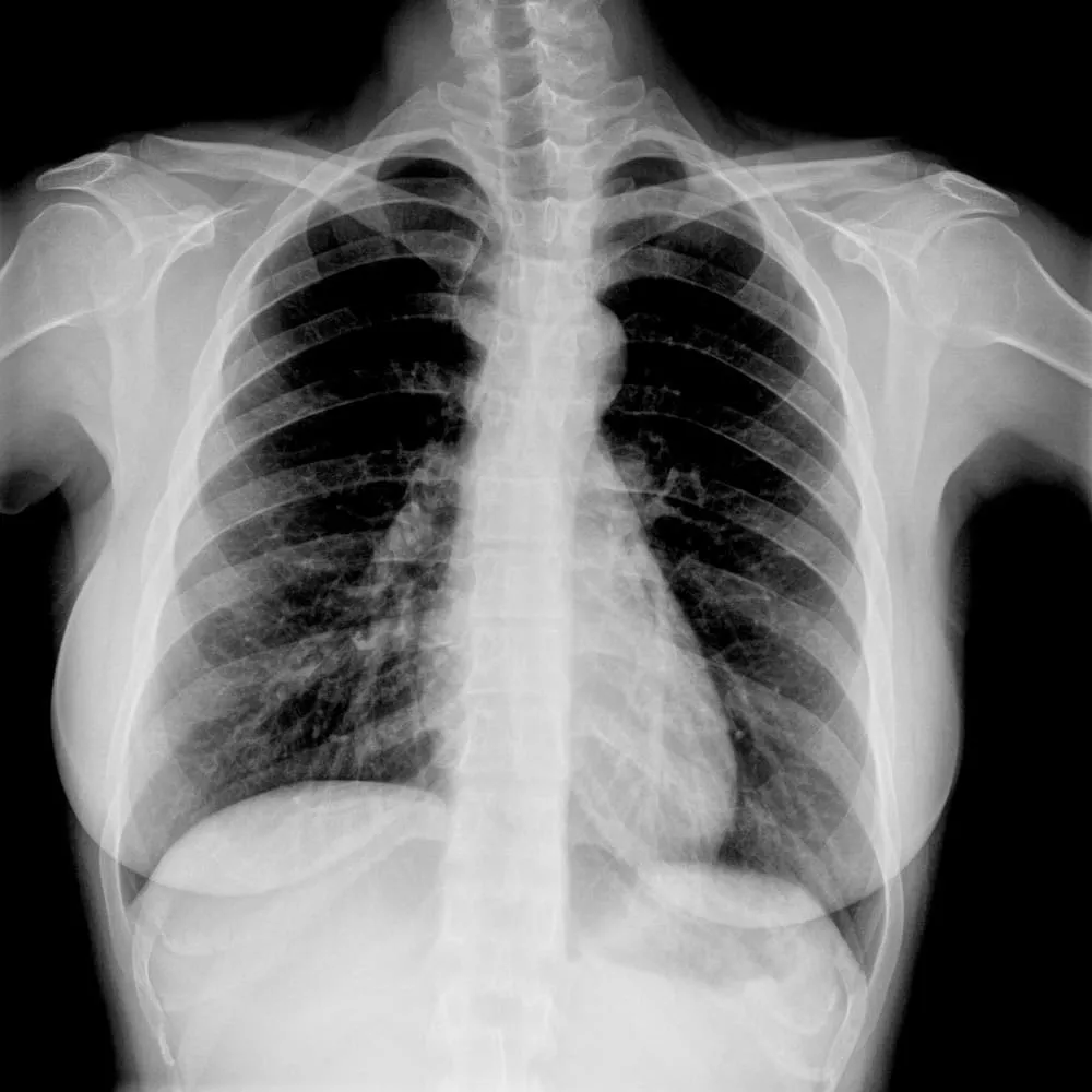 Chest X-ray showing lungs, ribs, spine and heart viewed from the front.