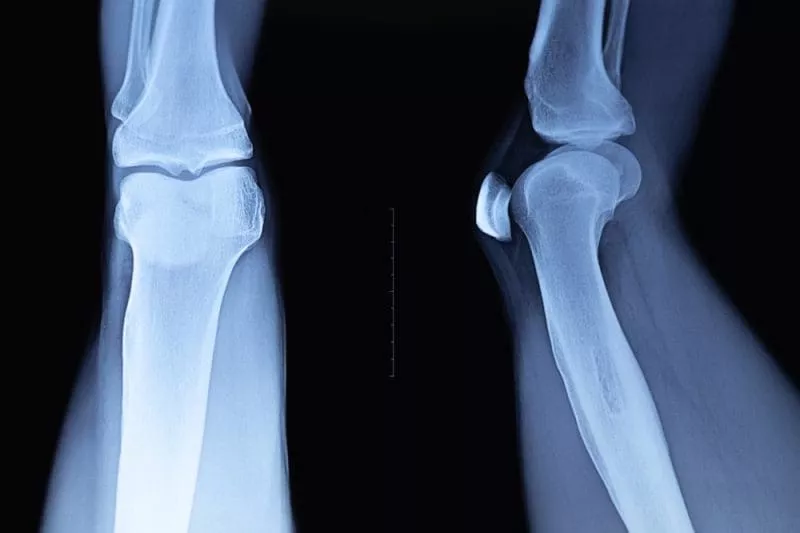 X-ray showing front and side views of a knee joint, including the femur, tibia, and kneecap.