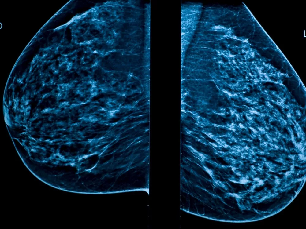 3D Mammogram