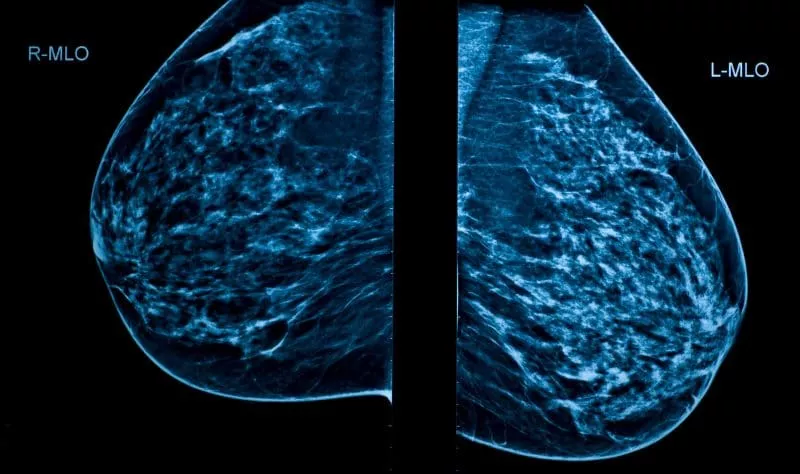 Radiologists and AI Mammogram Tools: What’s Next in Screening?