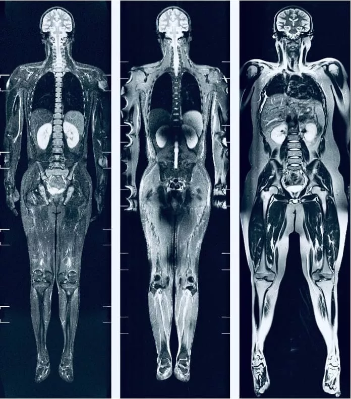 Three full-body MRI images showing front-facing views of the human skeleton and internal organs on a dark background.