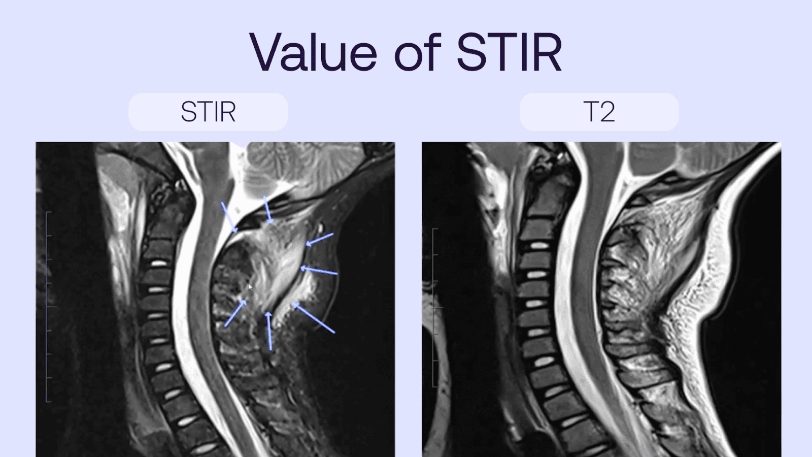 STIR vs T2 MRI comparison showing improved detection of soft tissue abnormalities